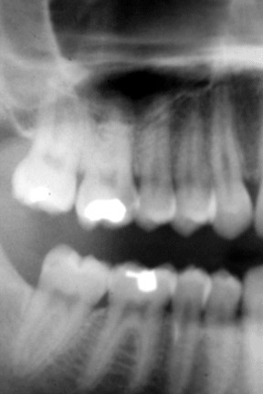 Diş Röntgeni Çektirenler Dikkat!