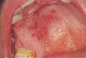 Dudaklarda Uçuk ve Ağız Kenarında Kabarcıklar HSV stomatit