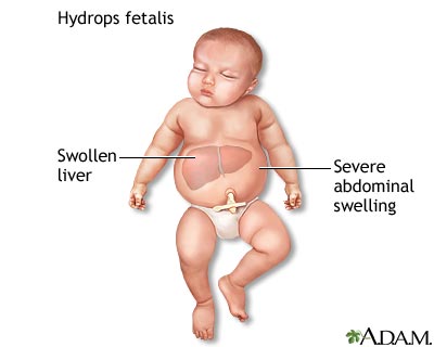 NON-immune hydrops fetalis