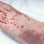 purpura
