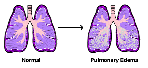 Akut Pulmoner Ödem Nedir? ( Akciğer Ödemi )