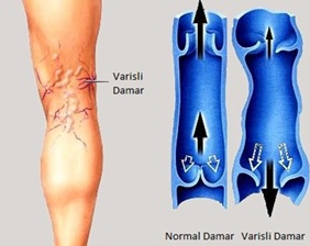 Varis nedir?