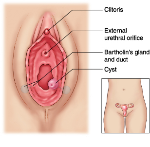 Bartholin Kisti, Bartholin Absesi Nedir ?