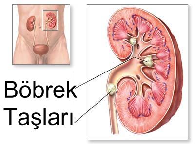 Böbrek Taşı, Böbrekte Taş Oluşması