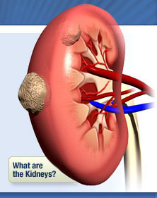 Böbreğin İyi ve Kötü Huylu Tümörleri