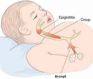 Bronşit Nedir? Belirtisi ve Tedavisi Nasıldır?