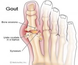 Gut Hastalığı Nedir? Tanı ve Tedavisi nasıldır?