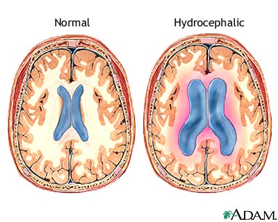 Hidrosefali Hakkında Bilgi ( Sağlık Personeli İçin )