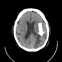 İnme ( Stroke ) Nedir ? Risk Faktörleri Nelerdir ? Tedavisi Nasıldır ?