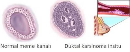 Meme Kanseri Hakkında Cevaplanan Soru…