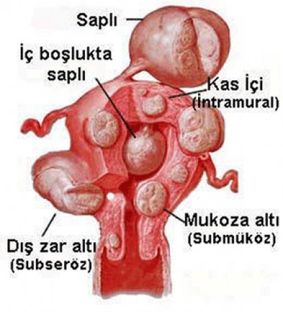 Miyom Nedir? Miyom Türleri Nelerdir?