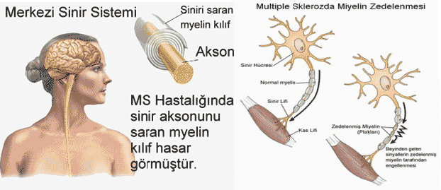 MS hastaları bu bilgilere dikkat!