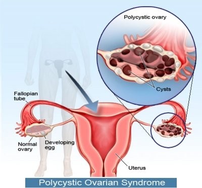 Polikistik Over Sendromu (PCOS) Nedir ?