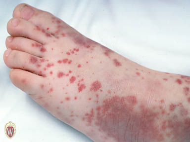 idiyopatik trombositopenik purpura