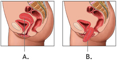 Rahim Sarkması ( Prolapsus Uteri )