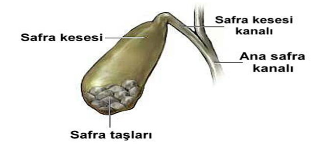 Kolesistit Nedir? Belirti ve Tedavisi Nasıldır?