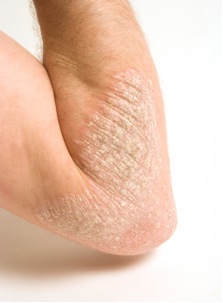 Sedef Hastalığı ( Psoriasis )