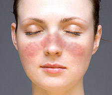 Sistemik Lupus Eritematozis Nedir?