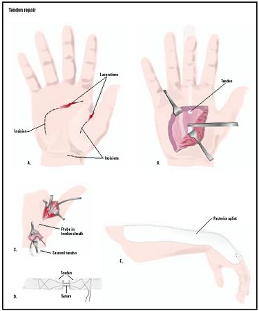 Tendon Onarımı Bilgi