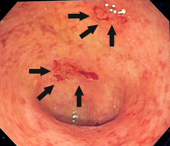 Ülseratif Kolit Nedir? Tanısı ve Tedavisi Nasıl Konur?