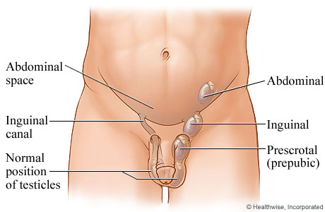 Undescended Testicle ( Cryptorchid Testicle)