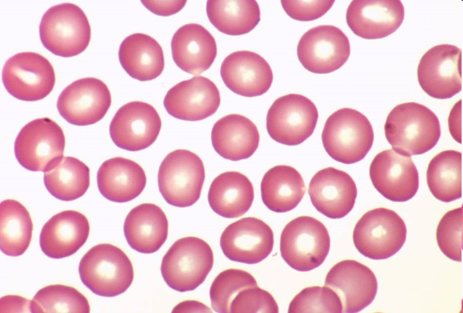 What is Anemia?